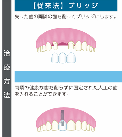 インプラント | 富士見台さくら歯科